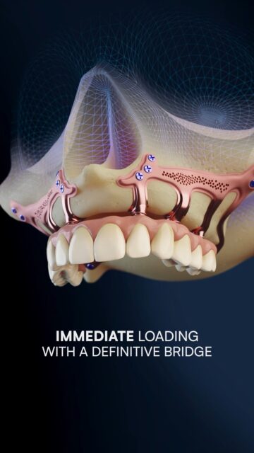 A New Approach to Severe Bone Atrophy
Severe bone atrophy remains one of the most challenging situations in implantology.
This video illustrates an alternative approach based on digital subperiosteal implants.
A concept designed to overcome the limitations of conventional grafting procedures.
By combining CBCT imaging, CAD design, and patient-specific manufacturing, it becomes possible to rethink anchorage, biomechanics, and treatment timelines.
The use of pterygoid anchorage, a fully digital workflow, and immediate loading protocols allows treatment in a single surgical stage, with a definitive prosthesis delivered on the same day.
More than a technique, it reflects the evolution of implantology toward precision and engineering-driven solutions.
#implantology #dentalimplants #subperiostealimplant #digitaldentistry #cadcamdentistry #cbct #oralimplantology #fullarch #severeatropy #pterygoidimplants #immediateloading #dentaleducation #dentalsurgery #biomechanics #prosthodontics #oralrehabilitation #3ddentistry #customimplants #titaniumimplants #dentistlife