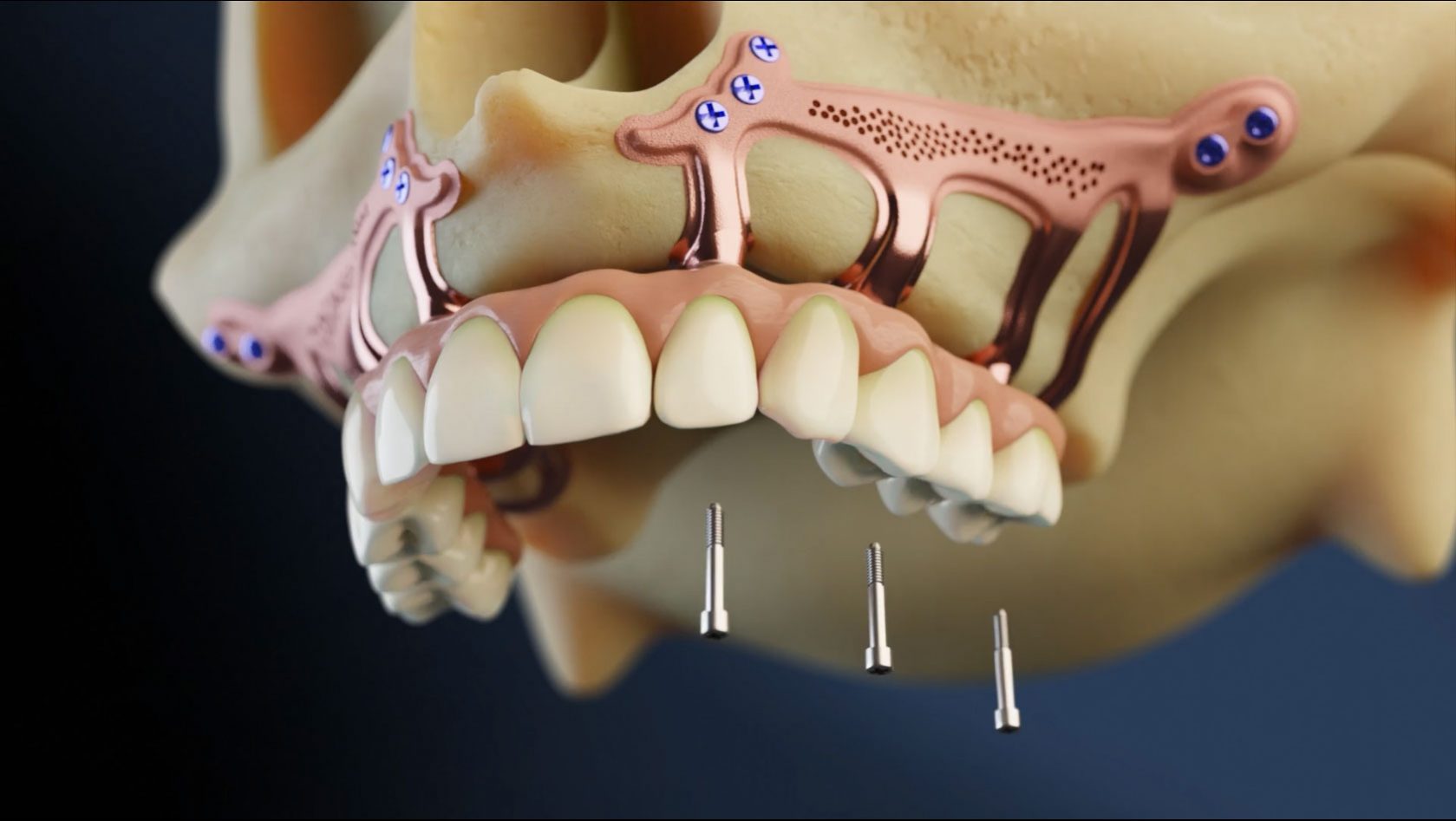 OPLEIDING SUBPERIOSTALE IMPLANTATEN – 13 juni 2026 – NICE - Afbeelding 2