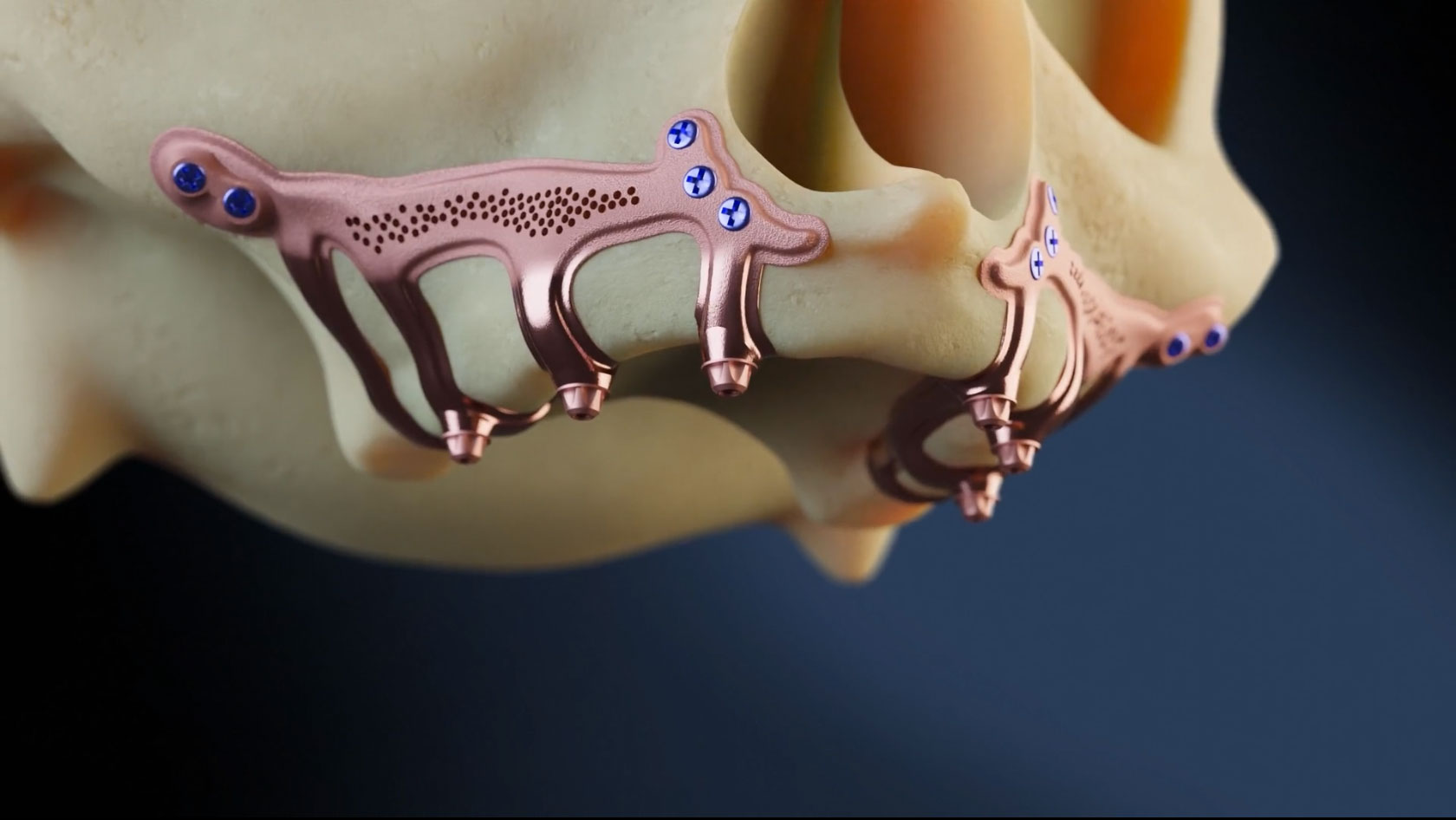 OPLEIDING SUBPERIOSTALE IMPLANTATEN – 13 juni 2026 – NICE - Afbeelding 3