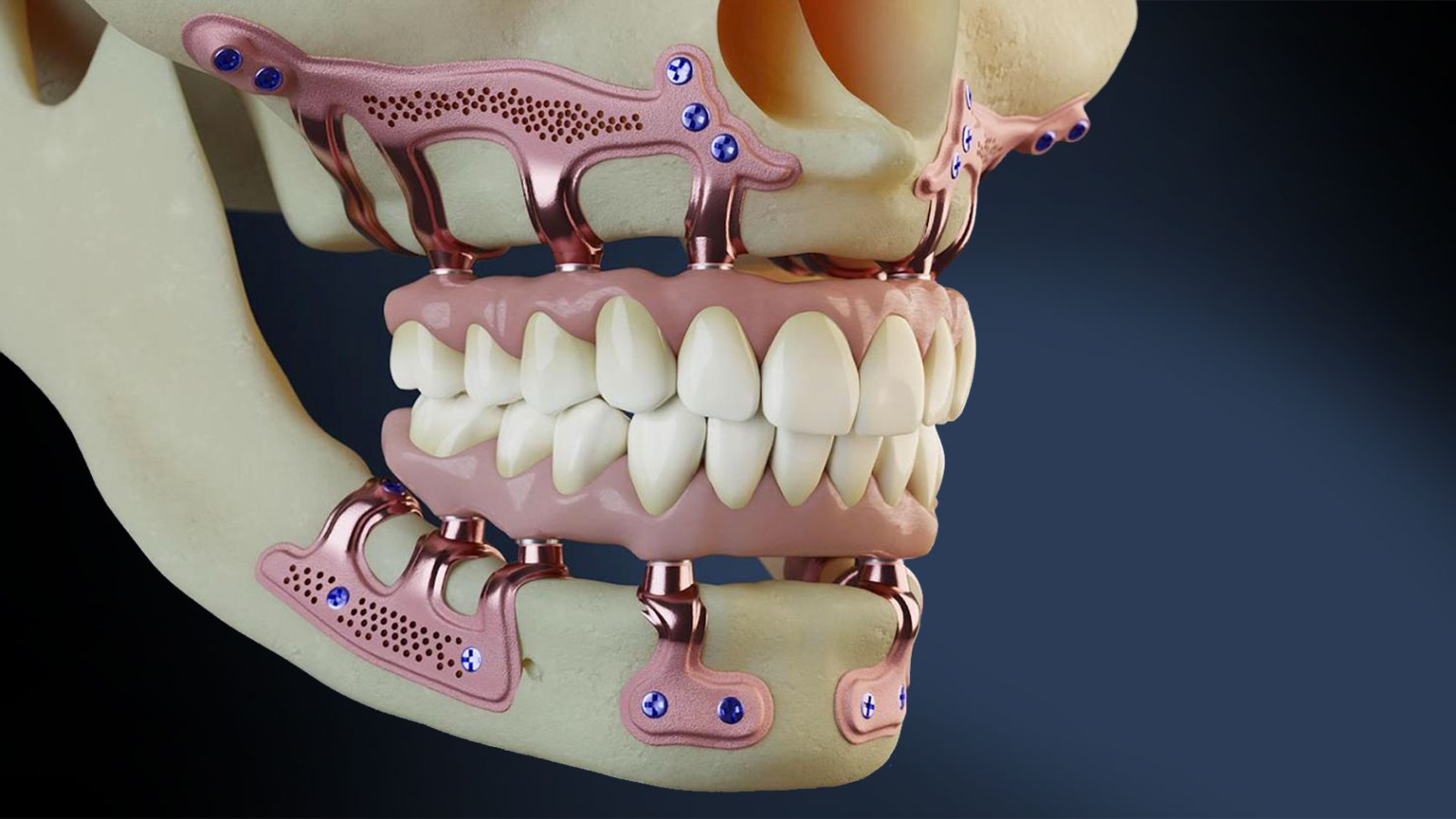 OPLEIDING SUBPERIOSTALE IMPLANTATEN – 13 juni 2026 – NICE